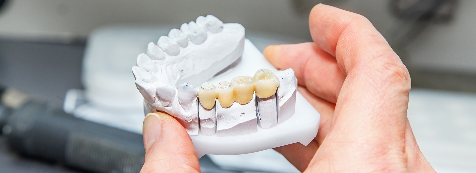 A person holding a white model of a set of teeth with missing front teeth.