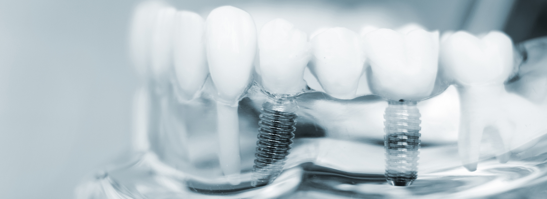 The image displays a close-up view of dental implants with visible screws, set against a blurred background.