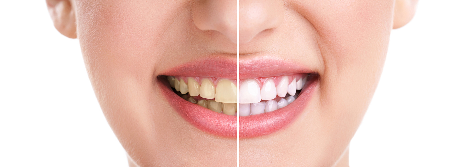 The image shows a close-up of a person's face with an overlay of text that appears to be a meme, featuring two images of teeth side by side with one labeled 'before' and the other 'after.