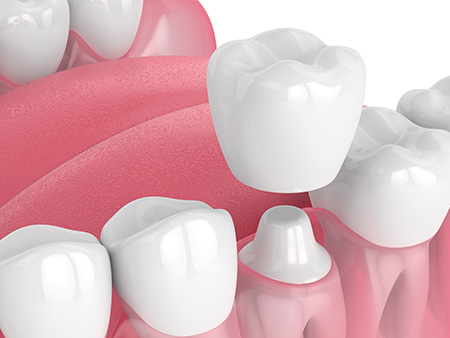 This is a close-up image of several artificial teeth displayed against a red background, showcasing their design and color variations.