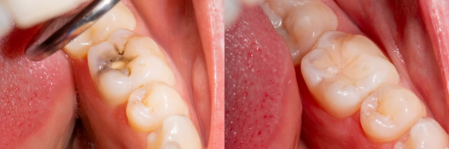 The image shows a close-up view of an open mouth with multiple teeth missing, revealing gum tissue and tongue, against a blurred background.