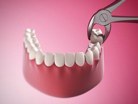 The image shows a close-up of a dental implant procedure with a pair of pliers holding a tooth in place, indicating dental implant placement or maintenance.