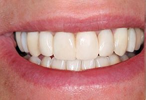 The image shows a close-up of an adult human mouth with a wide smile displaying straight, white teeth, and the person has a full set of upper and lower dentures.