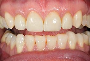 The image displays a close-up view of a person s teeth with an open mouth, revealing yellowed front teeth and gums, suggesting poor oral hygiene or dental issues.