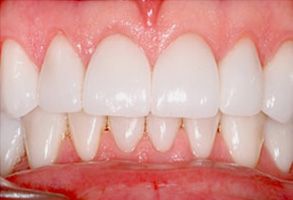 The image displays a close-up view of a person s teeth with a focus on their lower front teeth, which are prominently white and appear to be well-maintained.