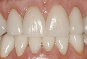 The image shows a close-up view of a person s teeth with a focus on a large gap between them, which suggests a need for dental treatment.