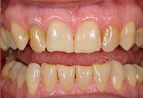 The image shows two close-up views of a person s mouth with yellowed teeth, displaying signs of decay or discoloration.