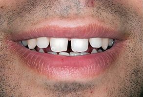 The image shows a person with a broad smile revealing teeth, including a prominent gap between two front teeth, and their lips are slightly parted.