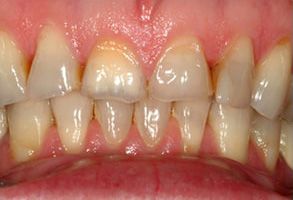 The image shows two close-up photographs of a person s teeth with discoloration and staining, emphasizing dental hygiene concerns.