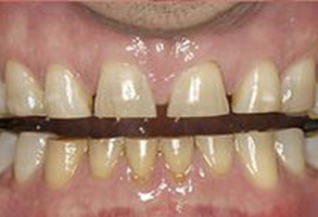 The image shows a person s teeth with yellowish stains, some of which are being held together by a metal bar, suggesting dental work such as braces or a retainer.